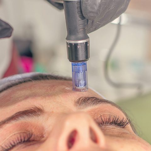 Microneedling | Sigma Dermatology